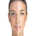 Acne Treatment Market - TechSci Research