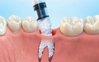 Dental Bone Graft Substitute Market - TechSci Research