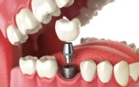 Dental Implants Market - TechSci Research