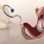 Intragastric Balloons Market - TechSci Research