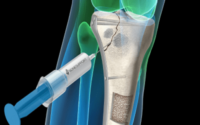 Bone Void Fillers Market - TechSci Research