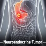 Neuroendocrine Tumor Market - TechSci Research