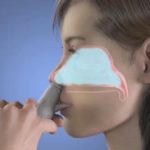 Nasal Drug Delivery Market - TechSci Research