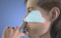 Nasal Drug Delivery Market - TechSci Research